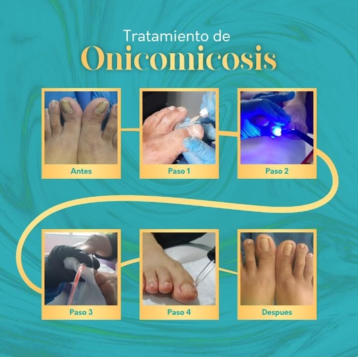 Tratamiento de Onicomicosis